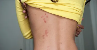 Можно ли определить по фото кто укусил: клоп или комар?» — Яндекс Кью