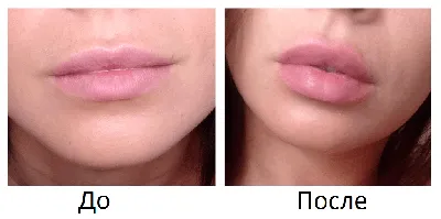 Увеличение губ картинки обои