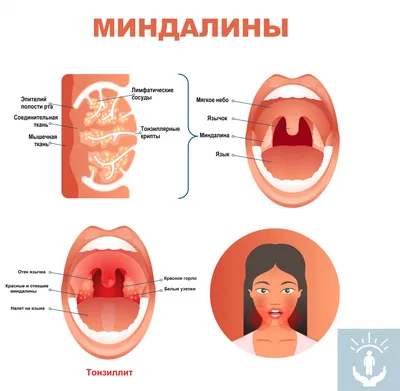 Ангина - лечение эффективно и надежно в Ростове-на-Дону
