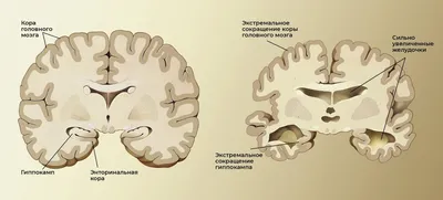 Ученые выявили новый признак болезни Альцгеймера | Inbusiness.kz