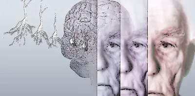 Болезнь Альцгеймера у пожилых людей: лечение, диагностика