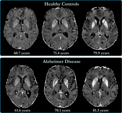 Болезнь Альцгеймера: причины, возраст, диагностика, лечение, профилактика -  Российская газета
