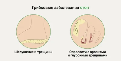 Грибок кожи головы – лечение грибка головы в Москве, цены – An-Tech Labs