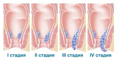 Лечение геморроя в Киеве, цена операции по удалению геморроидальных узлов |  Medcity