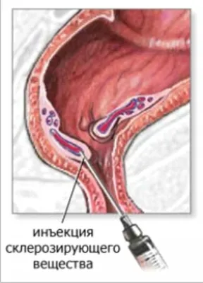 Лечение геморроя со свищем в медицинском центре «Я здоров», цены в  Новосибирске