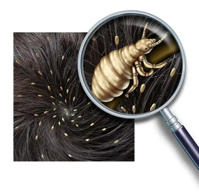Как выглядят гниды — фото на волосах, яйца вшей под микроскопом