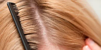 Отличия гнид на волосах от перхоти, как избавиться от педикулеза?