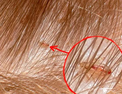 ᐉ Вши: фото как выглядят укусы вшей на теле, голове и волосах человека