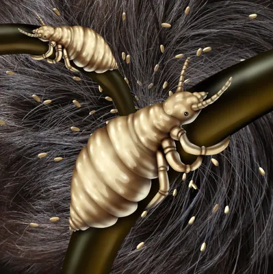 Как выглядят гниды (яйца вшей) на волосах - фото под микроскопом | Паранит