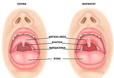 Красное горло у грудничка — симптомы и лечение состояния — клиника  «Добробут»