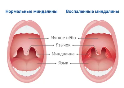 Чем лечить красное горло у ребенка: о способах лечения, воспаление и  першение в горле — читайте в статье блога Furasol®