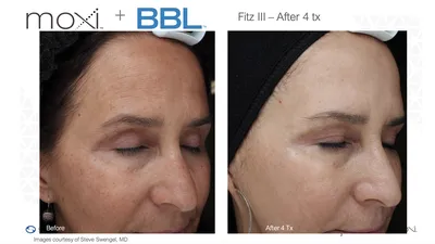 Sciton's BBL and Moxi Laser Treatment in Boca Raton | Glamor Medical