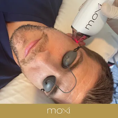 Moxi Laser Treatment • Skin Pharm