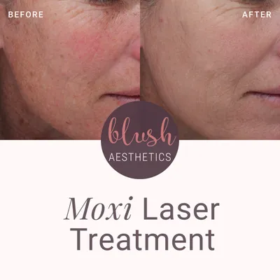 MOXI® Laser Treatment in Ashburn, VA - NOVA Plastic Surgery and Dermatology