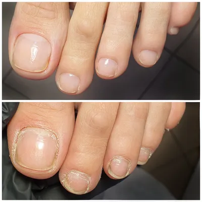 Обгрызанные ногти до и после (57 фото)