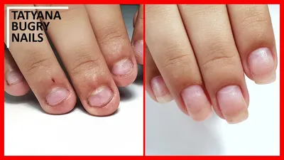 Последствия вредной привычки: как восстановить обгрызенные ногти? | sun