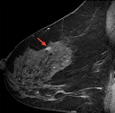 Магнитно-резонансная томография (МРТ) грудной клетки