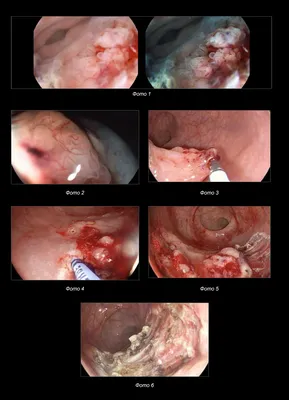 Рак губы: причины, симптомы, стадии, как выглядит, как определить
