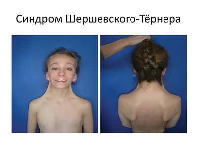 Синдром шерешевского тернера картинки обои