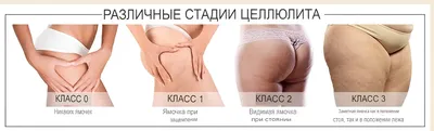 daria__massage - ЦЕЛЛЮЛИТ И ЕГО СТАДИИ Целлюлит - это... | Facebook