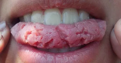 Инфекционные заболевания слизистой оболочки полости рта